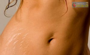 Life style  -   0113      Cures-stretch-marks