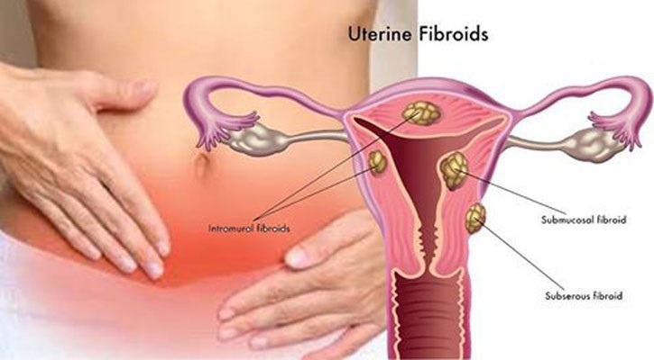 http://coxview.com/wp-content/uploads/2021/08/Health-Uterine-Fibrods-.jpg