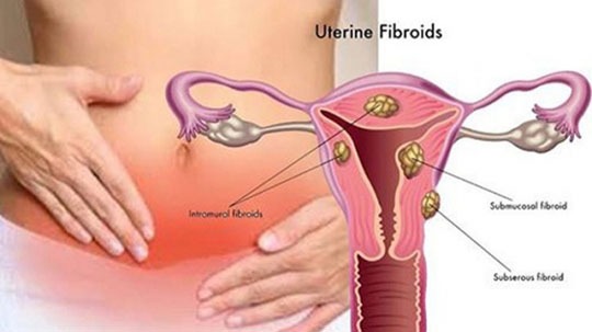 http://coxview.com/wp-content/uploads/2021/08/Tumors-of-the-cervix-.jpg