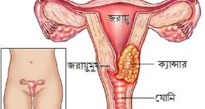 http://coxview.com/wp-content/uploads/2021/11/Health-Cervical-cancer-1-_copy_432x288.jpg